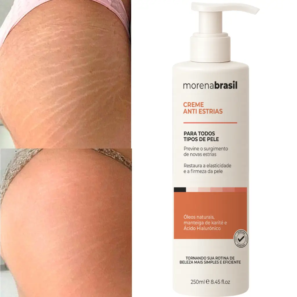 Creme AntiEstrias Removedor Estrias 200g Morena Brasil – Ação Poderosa com Colágeno e Elastina - 1